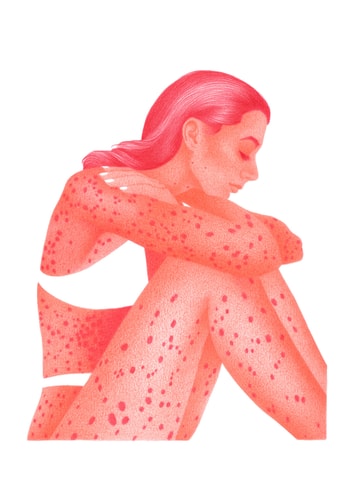 With my psoriasis - A4