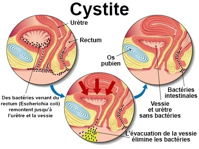 Cystite : comprendre cette infection urinaire fréquente et inconfortable