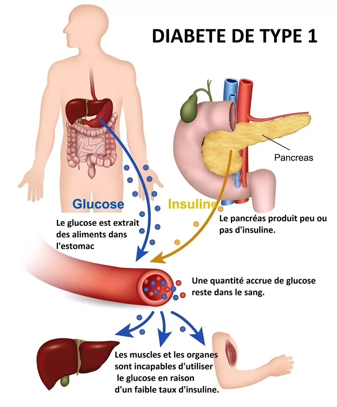 🩸 Diabète de type 1 : ce qu’il faut vraiment savoir sur cette maladie auto-immune